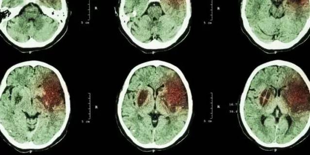 Stroke：斯坦福发现间充质干细胞治疗中风有奇效