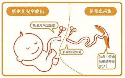 重磅消息！自体脐带血治疗7个月脑瘫儿获得成功